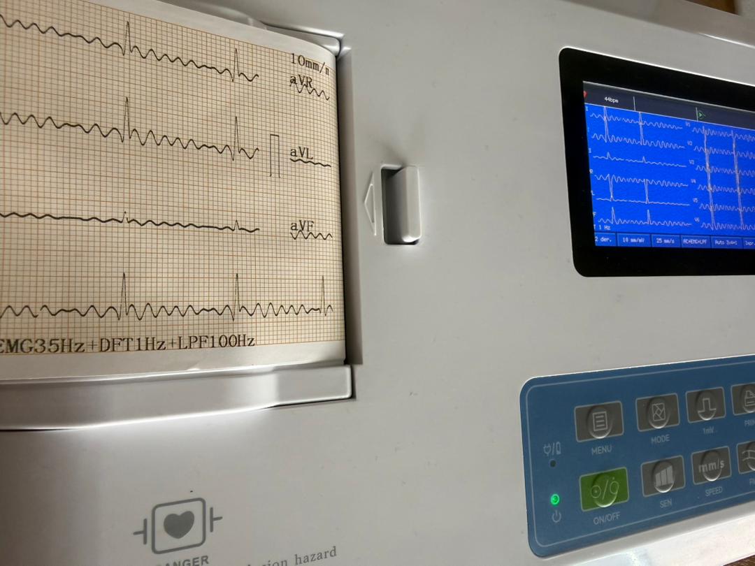 Fibrilación Auricular